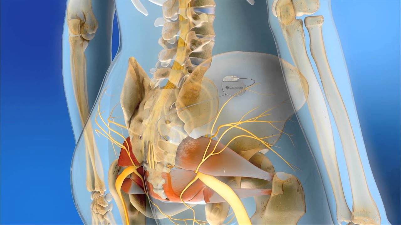 https://www.myhealthturkey.com/sacral-nerve-neuromodulation/